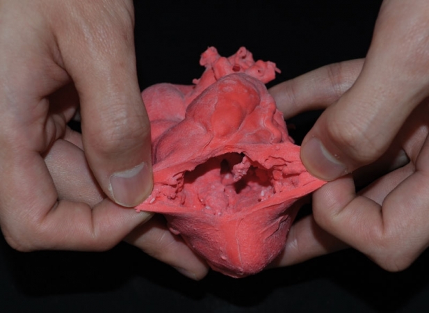 Pediatryczny model serca z transpozycją wielkich naczyń (ccTGA) oraz wadą wrodzoną typu VSD - zdjecie nr: 2